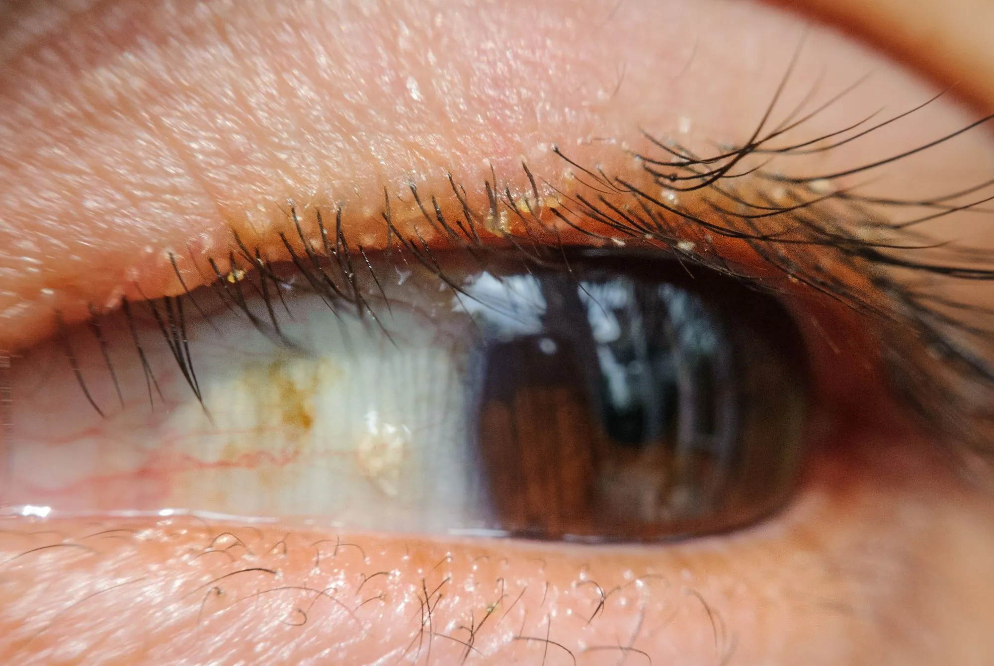 close up of an inflamed eye