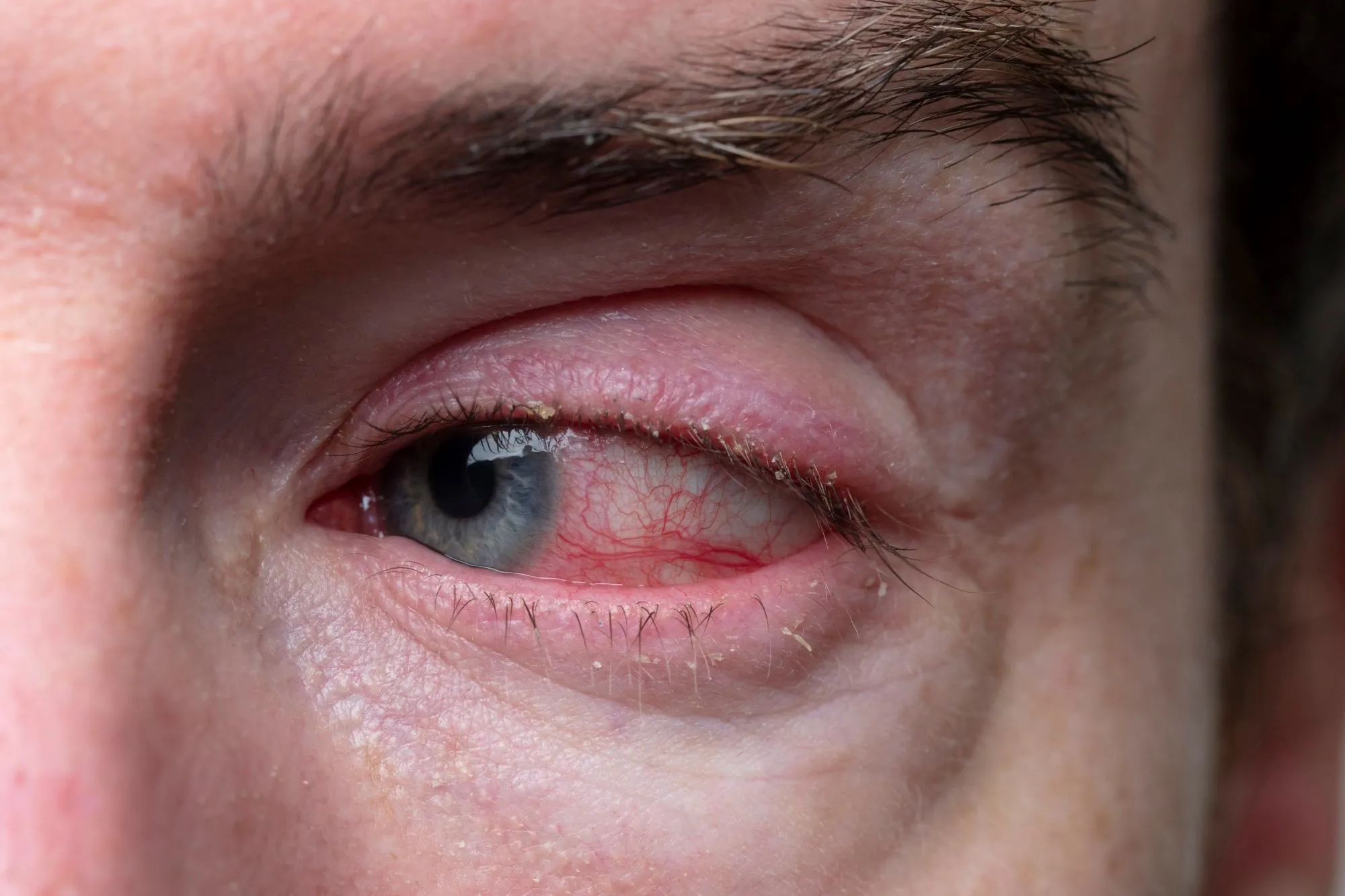 A swollen bloodshot eye looking inwards.