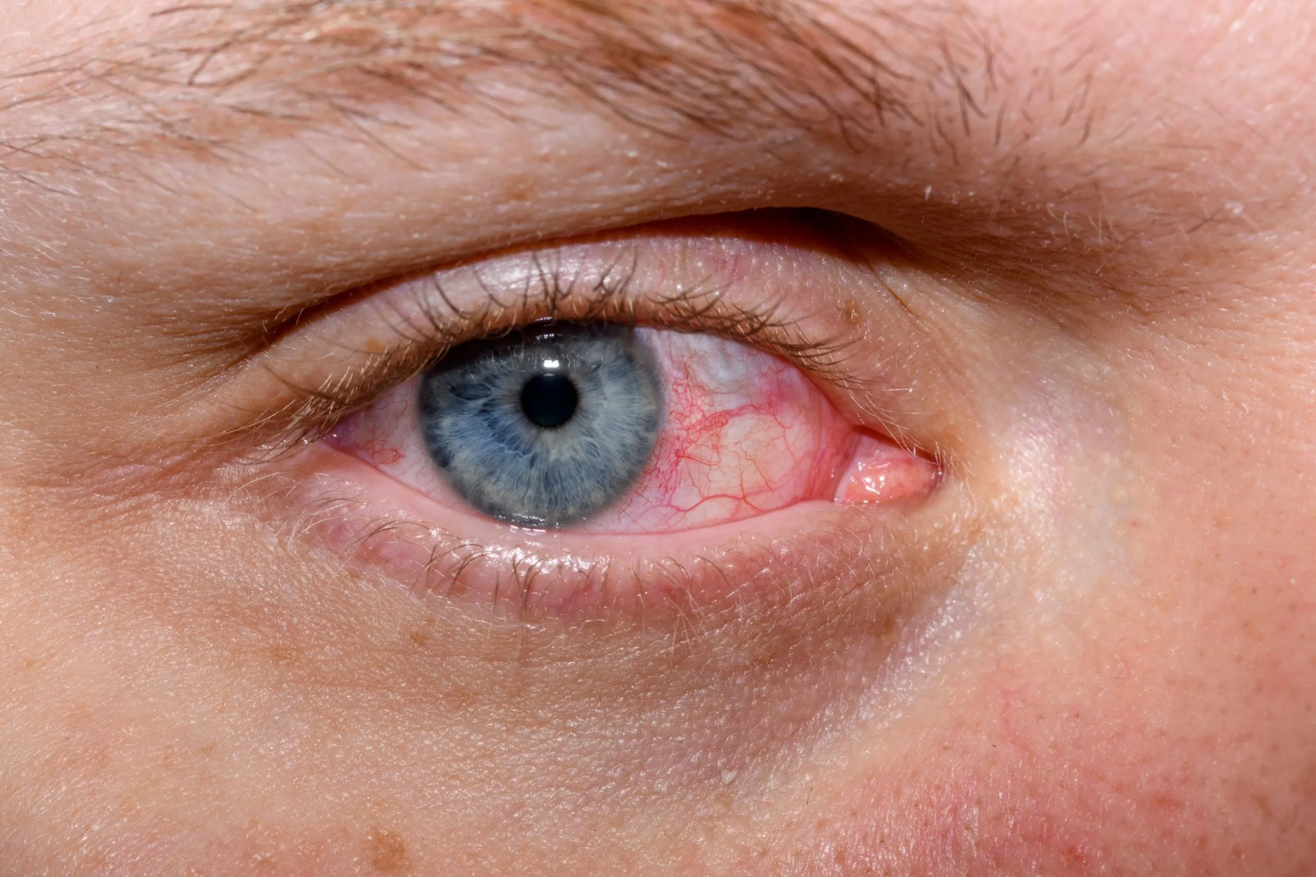 Close up of a red blood shot eye